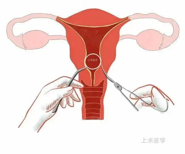 上环取环